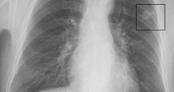 A large number of biomarkers could in the near future lead to tests that identify lung cancer early on