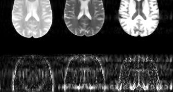 New algorithm can easily speed up MRI scan times