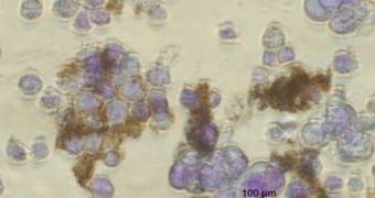 Nanoparticles, in brown, attach themselves to cancer cells, in violet, from the human abdominal cavity