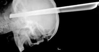 Man's brain gets impaled by metallic stool leg