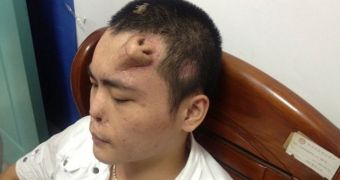 Man loses his original nose, has a new one grown on his forehead