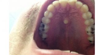 Extra tooth grows on roof of mouth