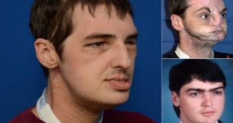 Man Undergoes Successful Face Transplant After Gun Shot to the Face