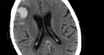 Measuring intracranial pressure could become a non-invasive procedure
