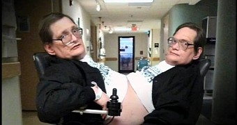 Meet Ronnie and Donnie Galyon, the World's Oldest Conjoined Twins