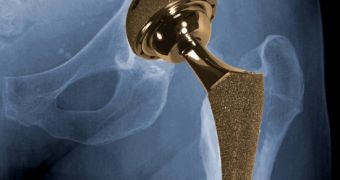 Metal-on-metal hip implants are likely to cause soft tissue damage, FDA report says