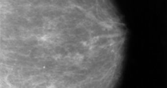 A mammography showing breast cancer (see arrow)