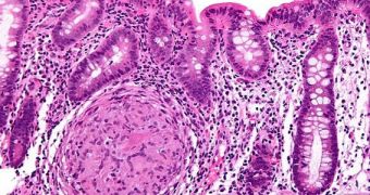 Biopsy showing inflammation of the colon in a case of Crohn's disease