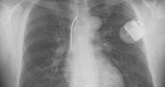 A normal chest X-ray after placement of an ICD, showing the ICD generator in the upper left chest and the ICD lead in the right ventricle of the heart