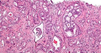 Micrograph image showing prostate cancer tissue