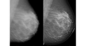 Digital breast mammogram pre- and post-Adara processing