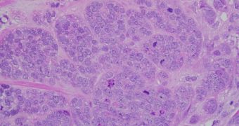 New approach could detect metastases before they kill