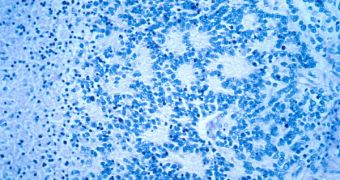 Neuroblastoma cells as they are seen in tumors on an infant's body