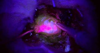 Glowing tumors could enable neurosurgeons to become more precise in their operations