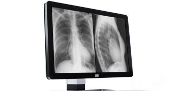 New 4096 x 2560 pixels, 30-inch 10 MegaPixel Display Used for Viewing X-Ray Images