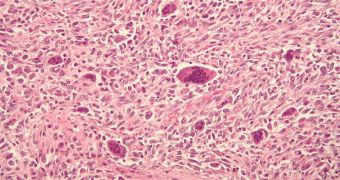Micrograph image showing bone cancer tissue