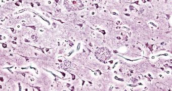 New Biomarker for Alzheimer's Discovered
