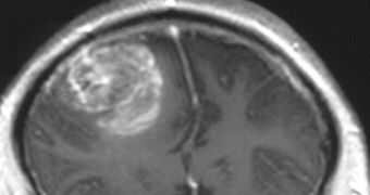 GBM in the human brain, as seen on an MRI scan