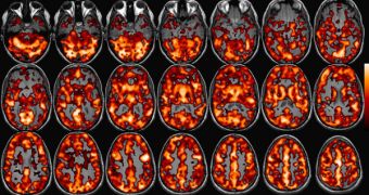 A photo of an MRI, detailing signs of schizophrenia
