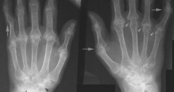 An X-ray image detailing the transformations of bones in rheumatoid arthritis