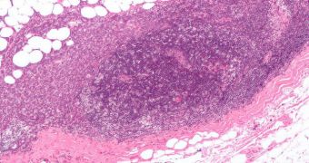 Ovarian cancer may soon be addressed with a new chemical, called NVP-BEZ235