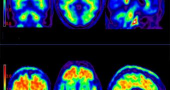 PET scans can easily reveal amyloid plaques in patients injected with a newly approved dye
