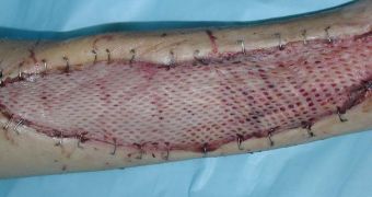 Skin graft applied after a rattlesnake bite
