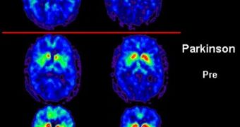 A PET scan can show patterns in the brain that aid the physician in diagnosing and treating the Parkinson's disease