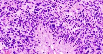 A histopathological slide showing glioblastoma cells