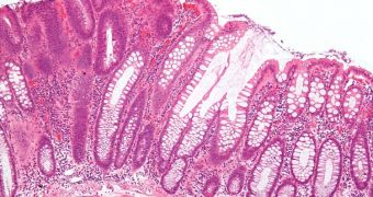 This micrograph shows a colorectal adenoma, a benign form of cancer that can turn malignant