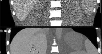 A new image reconstruction technique results in a better CT scan (bottom) of a human abdomen model than current algorithms (top)