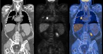 Scans showing lung cancer (bright spot in the chest). At left - CT scan; center - PET scan; right - combined CT-PET scan.