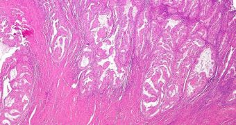 Micrograph image showing endometrial cancer cells