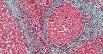 Micrograph showing fibrosis in the human liver