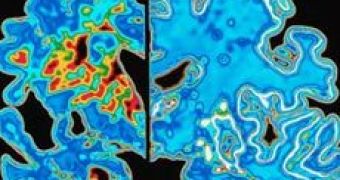 New Technique to Discover Early Alzheimer