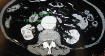 A contrast enhanced CT scan demonstrating an abdominal aortic aneurysm of 4.8 by 3.8 cm