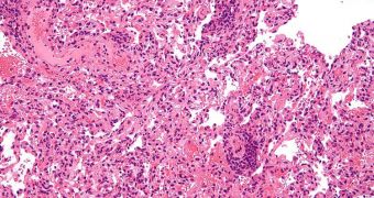 New Tool Developed Against Lung Transplant Rejection