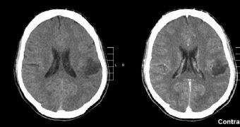 Glioma of the left parietal lobe. CT scan with contrast enhancement