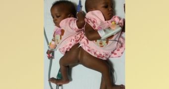 Twin conjoined babies are separated in India