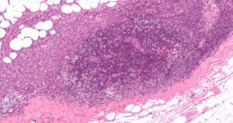 Micrograph showing a lymph node invaded by ductal breast carcinoma