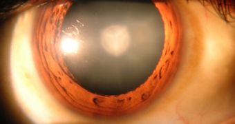 Early stages of cataract in the human eye, discovered via the use of a slit lamp