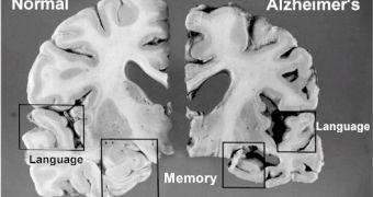 Brain: normal (left) and Alzheimer (right)