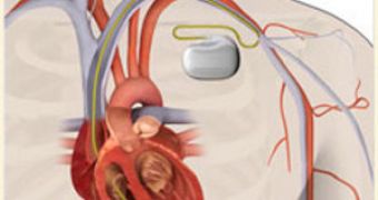 Pacemaker Gets Electricity from the Heart, Needs No Batteries