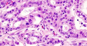 Micrograph showing pancreatic adenocarcinoma cells