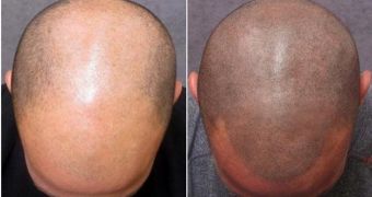 A hair tattoo creates the optical illusion of hair on one's scalp