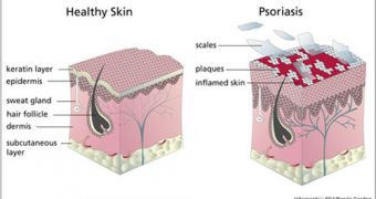 Psoriasis  produces major skin damage, but is not contagious
