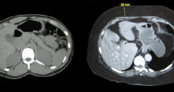 A magnetic resonance image (MRI) of the abdominal cavity of an obese person, as opposed to that of a slimmer one - notice the 3 cm of fat