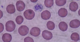Giant platelets are shown here on a blood smear