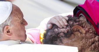 Pope Francis hugs man with neurofibromatosis
