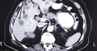 An MRI image showing the liver of a patient with multiple tumors